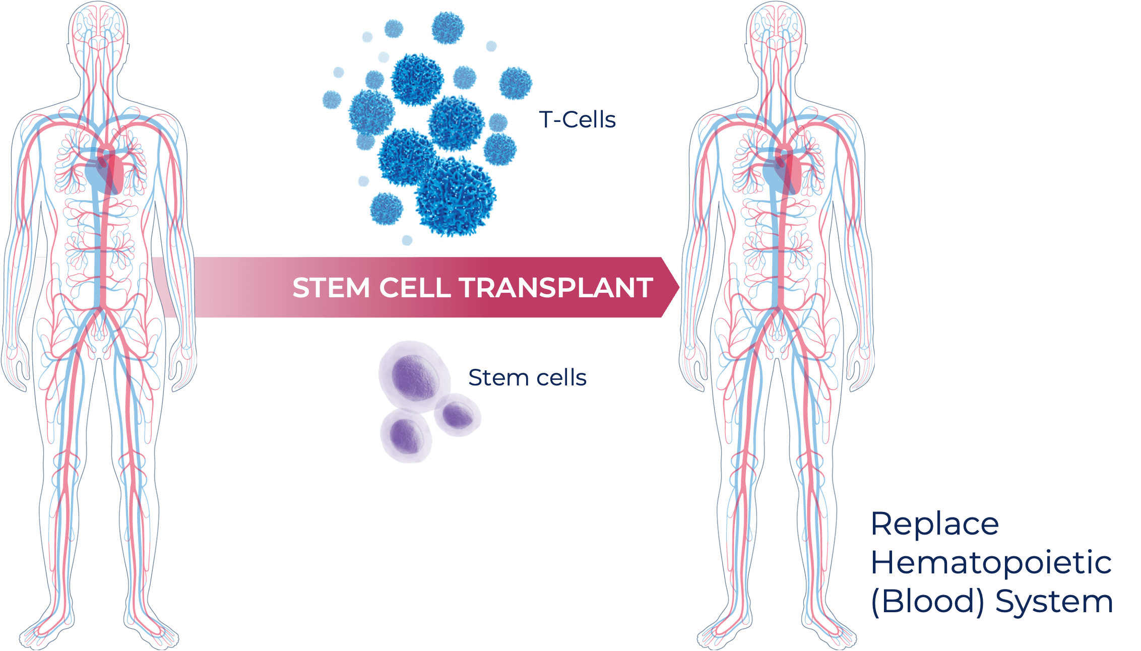 Stem Cell Transplant graphic